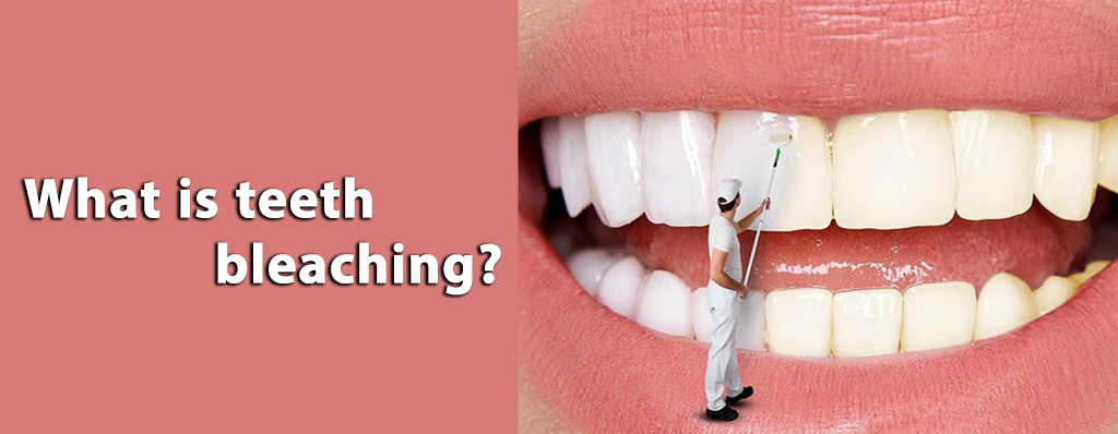 بلیچینگ دندان چیست؟ مزایا و معایب آن